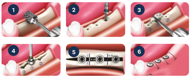Procedura TRUSA SPLIT MANDIBULAR ESSET KIT
